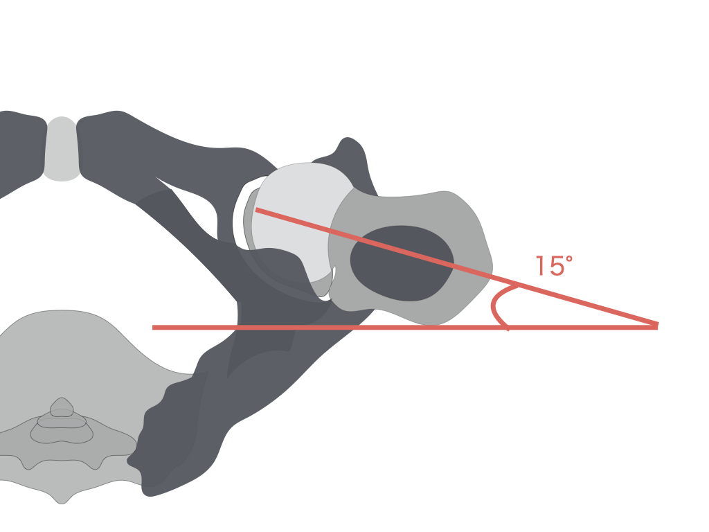 股関節骨折の診断